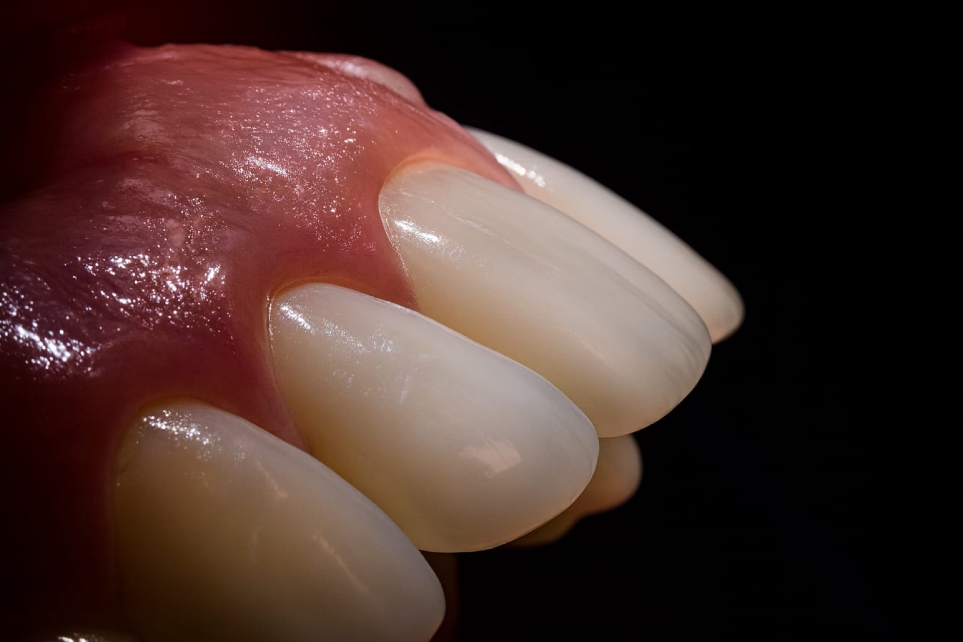 Veneers Düsseldorf — Makroaufnahme der hauchdünnen Keramikschalen direkt nach dem Einsetzen bei Dr. Pantas