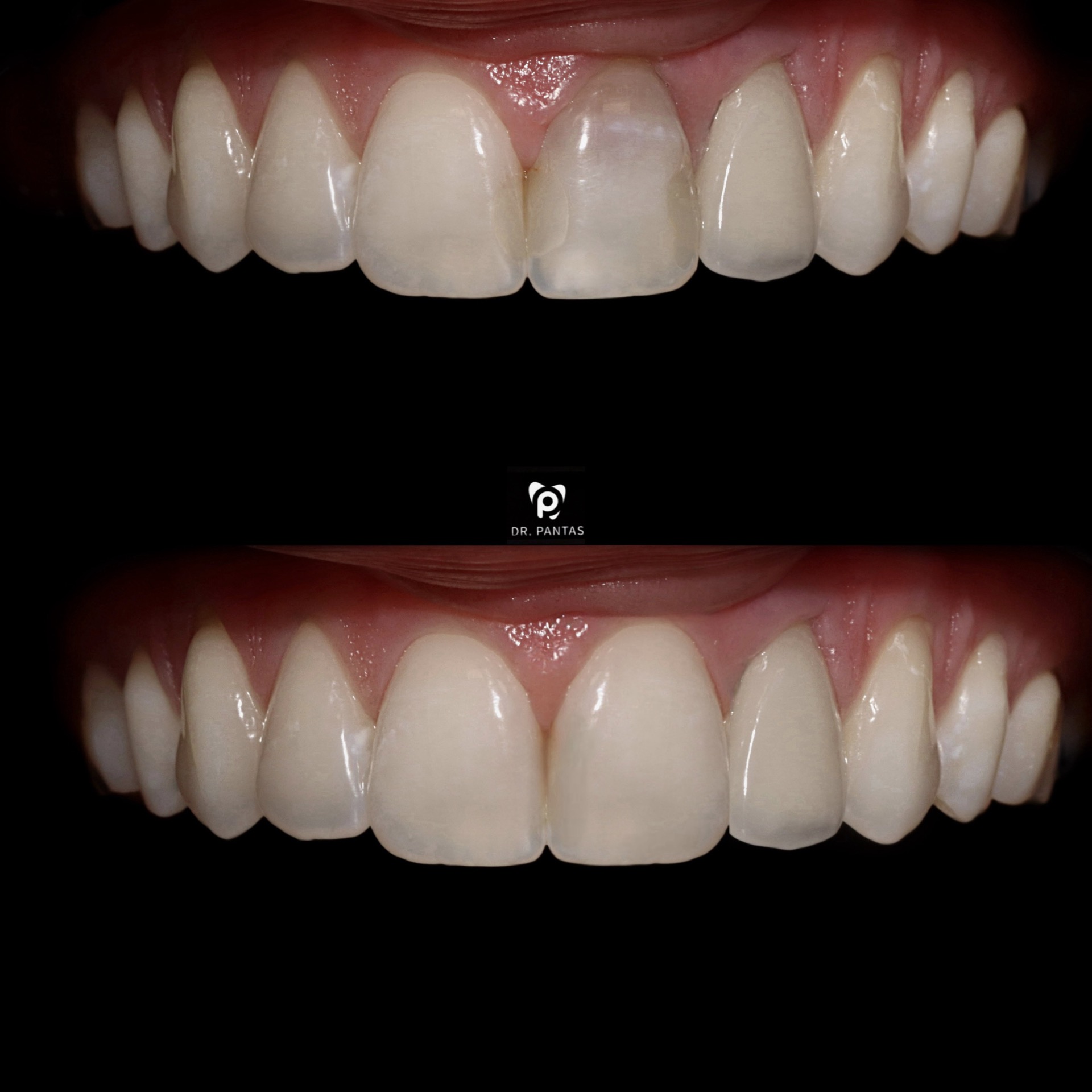 Veneers Düsseldorf — Vorher/Nachher: schiefe, verfärbte Frontzähne werden zu symmetrischem, hellem Lächeln durch hauchdünne Keramikschalen bei Dr. Pantas